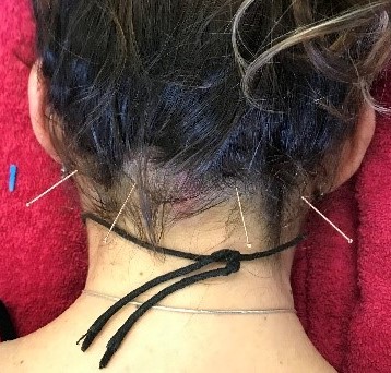 Acupuncture for headaches and neck pain