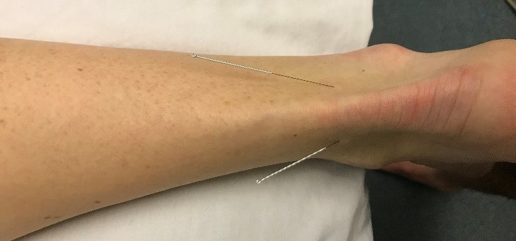 Acupuncture for Achilles injury in a runner