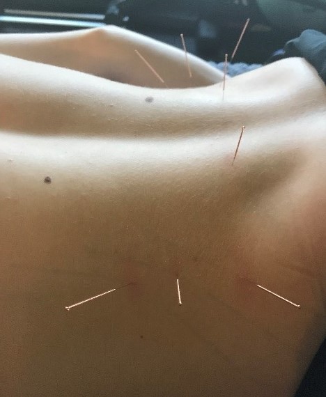 Acupuncture for low back pain